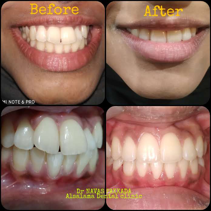 Fixed orthodontic treatment